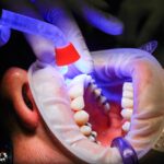 dentist, facet, uv light, curing, teeth, mouth, treatment, uv lamp, patient, clinic, dentist, dentist, dentist, dentist, dentist, teeth